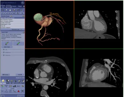 Figure 5 – Illustration de l’interface de Volume Viewer (application de GE Healthcare) pour la visualisation des coronaires reprise du travail de (Benseghir et al., 2015a)