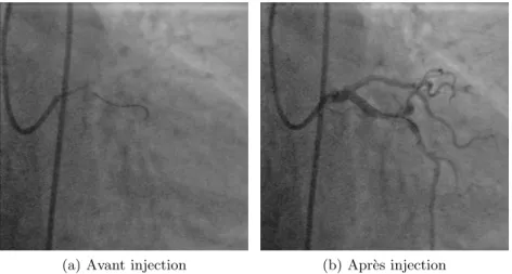 Figure 1.7 – Deux images angiographique montrant la mˆ eme anatomie, avant (a) et apr` es (b) injection de contraste.