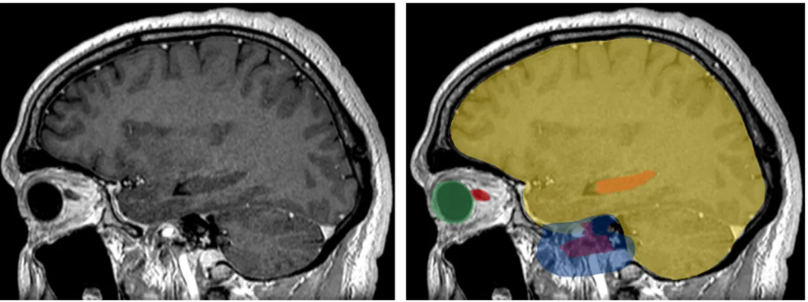 Figure 1.1: Segmentation of the target volumes and organs at risk in radiotherapy planning