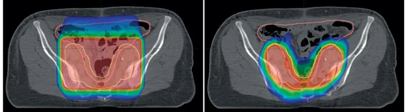 Figure I-4 : Comparaison d’une irradiation conformationnelle 3D (à gauche) et d’une irradiation avec  modulation d’intensité (à droite) sur les aires ganglionnaires pelviennes 