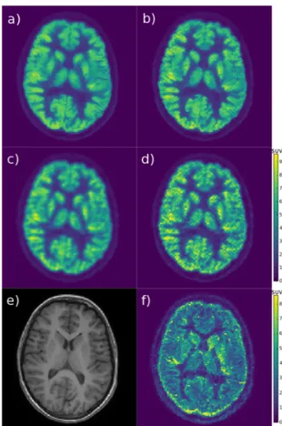 Fig. 5. Lesion exam: a) smoothed OSEM, b) OSEM, c) MR-MAP (T1w), d) MR-MAP (T2w), e) RCP-GS interval (both MR images), f) RCP-GS mean (T1w), g) RCP-GS mean (T2w), h) RCP-GS mean (both MR images), i) T1w MRI, j) T2w MRI, k) RCP-GS clustering sample; the OSE