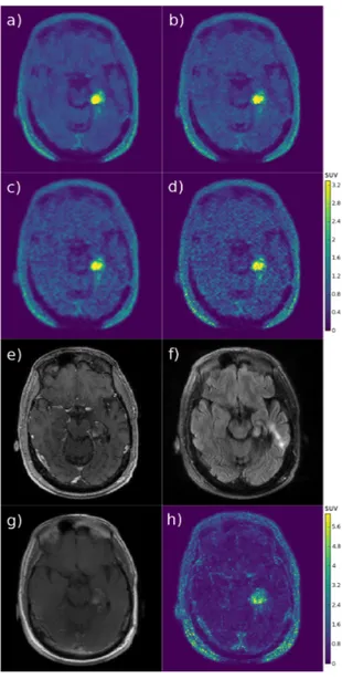 Fig. 7. Glioma exam: a) RCP-GS mean, b) MR-MAP, c) post-smoothed OSEM, d) OSEM, e) T1w MRI (Gd), f) FLAIR MRI, g) T1w late  enhance-ment MRI (Gd), h) RCP-GS 95% posterior intervals; the OSEM colorscale in SUV is common to all the PET emission images