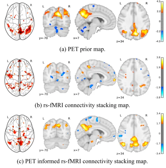 Figure 5: Spatial maps of AD/MCI classification coefficients. The parts of the default-mode network (involved in AD characterization) are  bet-ter recovered from the prior-informed stacking model than the stacking model without prior, since it has been imp