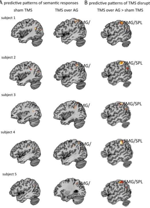 Fig. 1 e Multi-voxel single-subject analysis (MVPA) results from 5 representative individuals