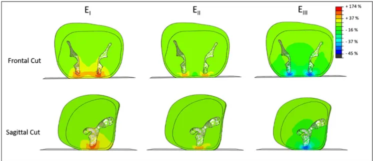 Fig. 3. Distribution of the principal Green Lagrange strains E I E II E III for the subject #1 in two cut plans near the ischium (Frontal and Sagittal)