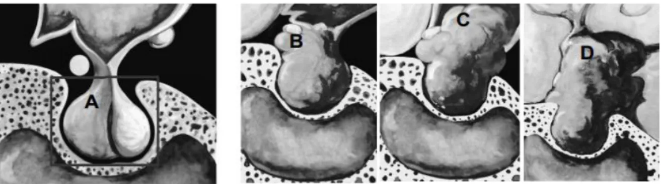 Figure 9 : Une glande hypophysaire normale (A) et trois autres exemples de croissance  anormale de la glande hypophysaire (B, C, D) (Cusimano et Goguen, 2016)