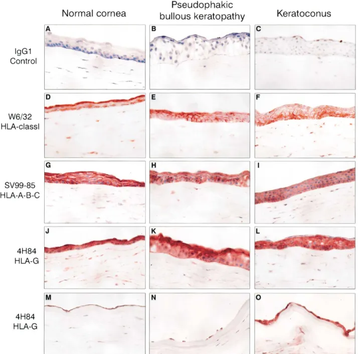 FIGURE 1 Detection of tissue antigens in normal corneas (first column), in pseudophakic bullous keratopathy (second column), and in keratoconus (third column)