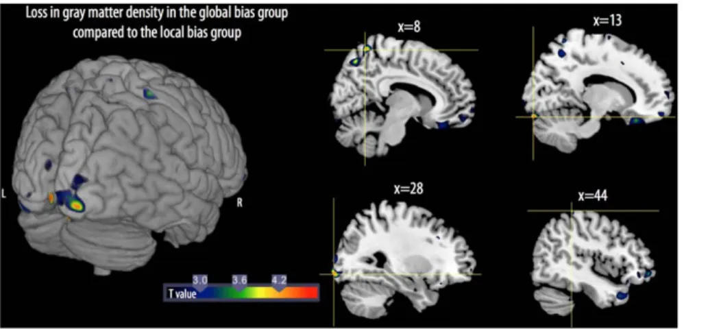 Figure 2. 3D rendering (left) and sagittal views (right) show the loss of gray matter volume between the local bias group and global bias group of children