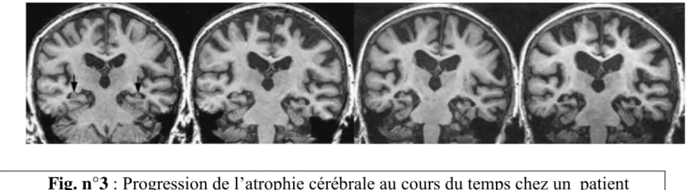 Fig. n°3 : Progression de l’atrophie cérébrale au cours du temps chez un  patient   atteint d’une maladie d’Alzheimer