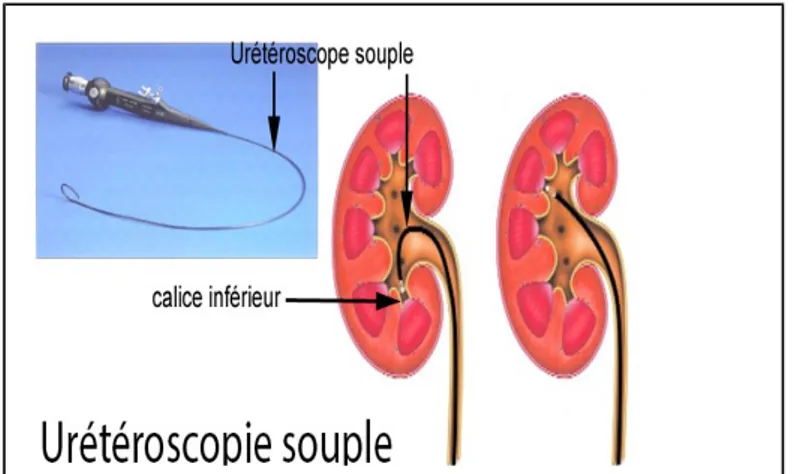 Figure I.2 : Principe de l’uretéroscope  