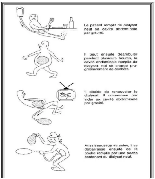 Figure n° 07 : Schéma simplifie les étapes de dialyse péritonéale (LEMEUR et al. 1998)