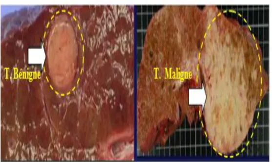 Figure  4 : la différence entre les  deux types de tumeur (Jean, 2005). 