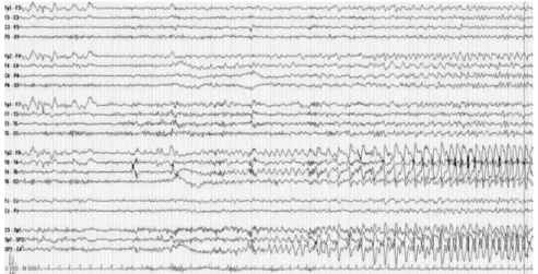 Figure 2.5: EEG recordings of a patient during epileptic seizure. The time series show potential differences between the two scalp electrodes marked on the left (e.g., Fp1-F3), named according to standard placement conventions