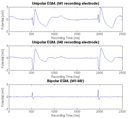 Figure 2.10: Sample unipolar (top and middle) and bipolar (bottom) intracardiac electrograms obtained from the CARTO navigation system.