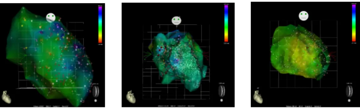 Figure 4.1: Screenshots of electroanatomical mapping data for Patients 1 (left), 2 (center) and 3 (right)