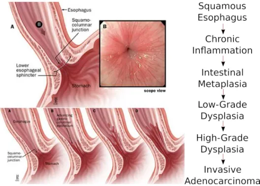Figure 2.1: Progression of dysplasia in the oesophagus. The observation of many stages provides room for early detection and treatment.