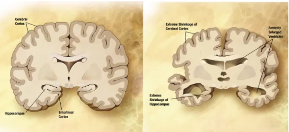 Figure 1.1: Diagram comparing normal adult brain (left) with a brain having AD (right) [Wikipedia 2016a]