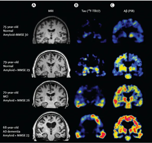 Figure 1.6: Figure reproduced from [Villemagne 2015], with permission, showing MRI and PET imaging of tau and Aβ in healthy controls, MCI and an AD patient.