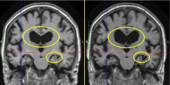 Figure 1.7: Coronal slices of an AD patient aligned for comparison from two struc- struc-tural MRIs acquired two years apart