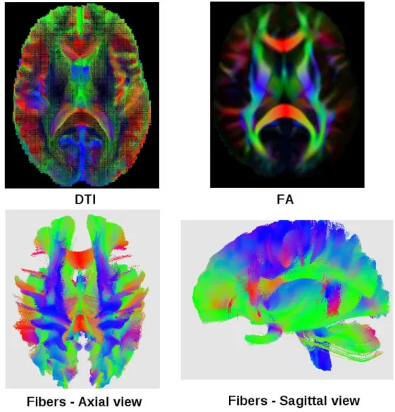 Figure 1.3: Diﬀusion tensor image (DTI) of the brain (top left). An associated fractional anisotropy (FA) directional map (top right)