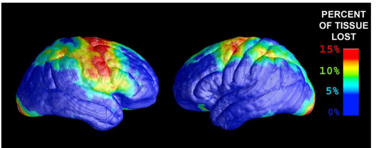 Figure 1.5: Brain tissue loss due to HIV/AIDS. Most damages are observed in regions controlling movement, memory and planning