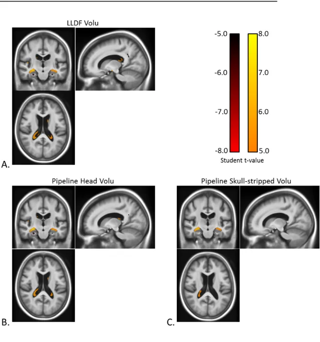 Figure 2.9: Corrected t-statistic map for the volume changes dierences between the patients with Alzheimer's disease and the healthy control group (for the 3 registration methods) on one slice: The three results present similar patterns with statistical di