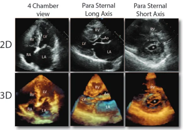 Figure 1.9: 2D and 3D echo images of the heart with the 3 different views.