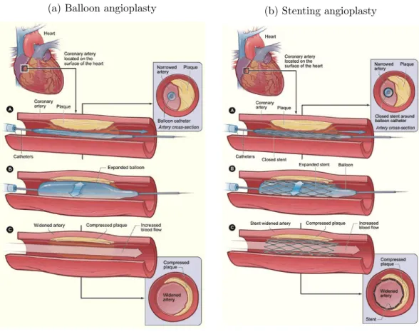 Figure 2.5: Illustration of an angioplasty procedure. (a) and (b) respectively illus- illus-trate the balloon angioplasty procedure and the stenting procedure.
