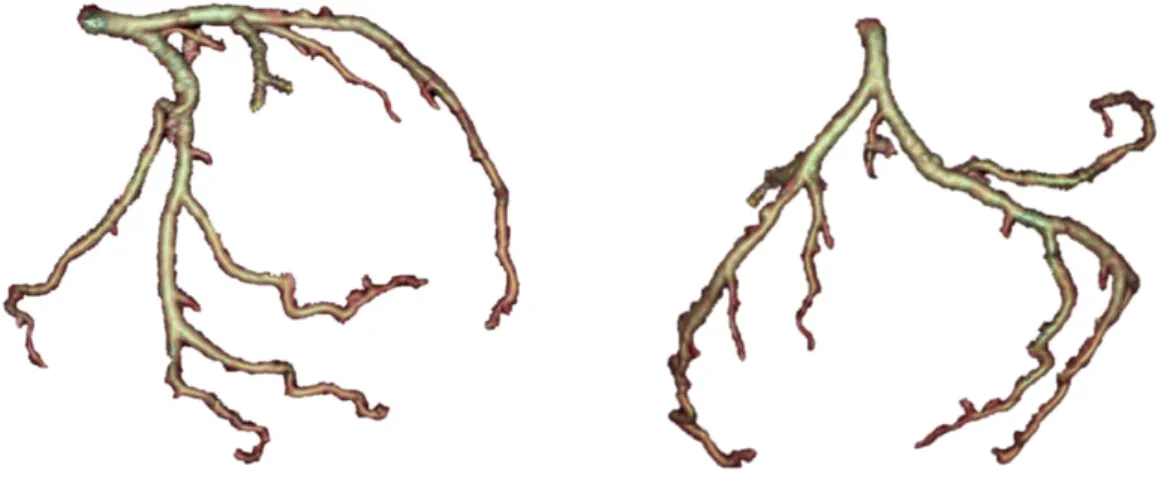 Figure 4.2: Volume rendering of a segmented coronary tree of the same patient seen from two diﬀerent angulations.