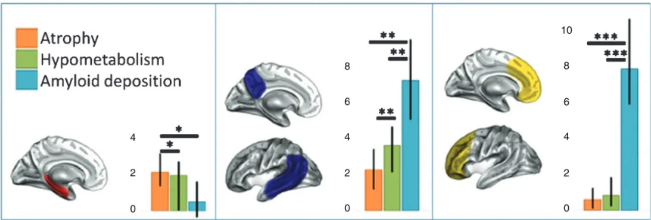 Fig. 5. Regional variation in the degree of biomarkers. Some regions show predominant atrophy (left panel), others have higher hypometabolism than atrophy (middle panel), and A ␤ deposition predominates in other areas (right panel)