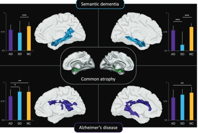 Fig. 7. Relationships between medial temporal lobe atrophy common to AD and SD (center panel) and whole-brain white matter density maps in patients with AD (top panel) and semantic dementia (bottom panel)