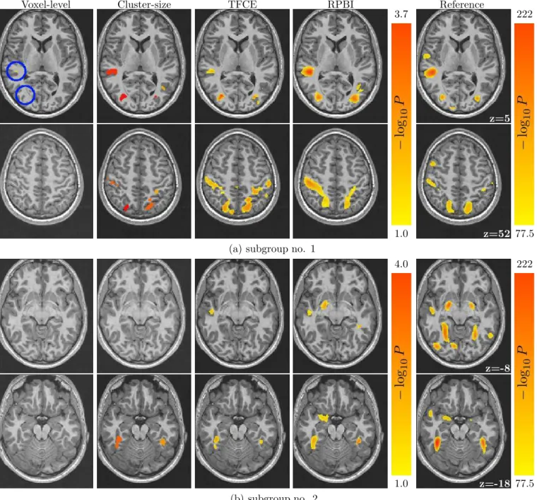 Figure 6: Negative logp-value associated with a non-zero intercept test with confounds (handedness, site, sex), on a [angry faces - control] fMRI contrast from the faces protocol