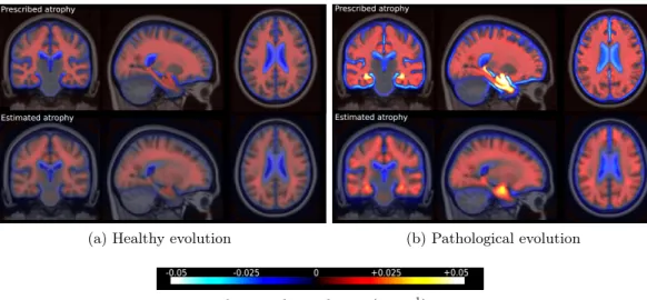 Figure 2.3: Simulated and estimated atrophy patterns in the template space. Top row: mean in the template space of the prescribed atrophy maps