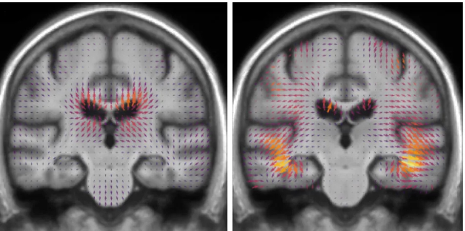Figure 2.5: Template image and SVFs parametrizing the two template trajectories SVFs. Left: normal aging trajectory v A showing a ventricular expansion related to a global atrophy
