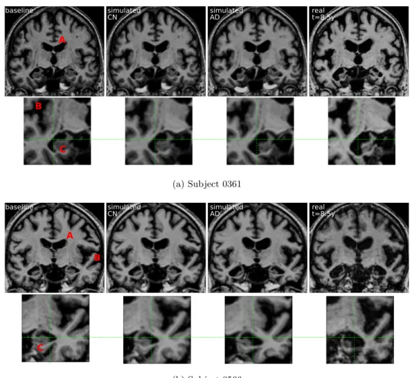 Figure 2.13: Evolution of the two subjects over 8.5 years. Both subjects were diag- diag-nosed MCI (for 5y and 3y) then AD