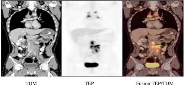 Fig. I.10 –  Principe de la fusion TEP/TDM [3]. 