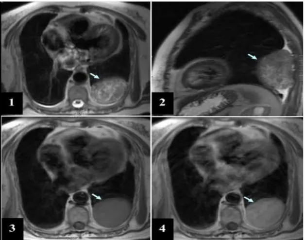 Fig. I.12  –  Image IRM thoracique. Séquences T2 en coupe axiale (1) et sagittale (2), T1 sans  (3) puis après injection de produit de contraste gadoliné (4)