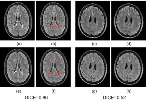 Fig. 2.5: Examples of WM lesion segmentation for a high and a low DICE.