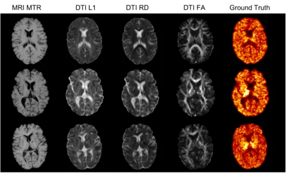 Fig. 3.1: Some examples of the ground truth ([ 11 C]PIB PET data) and input MR images including magnetization transfer ratio (MTR) and three measures derived from diffusion tensor imaging (DTI): fractional anisotropy (FA), radial diffusivity (RD) and axial