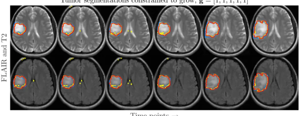 Fig. 1. Tumor volumetry of T2 (dashed lines) and FLAIR (solid lines) showing a clear advantage in the application of growth constraints (red) rather than leaving them out (green) when comparing with ground truth (blue).