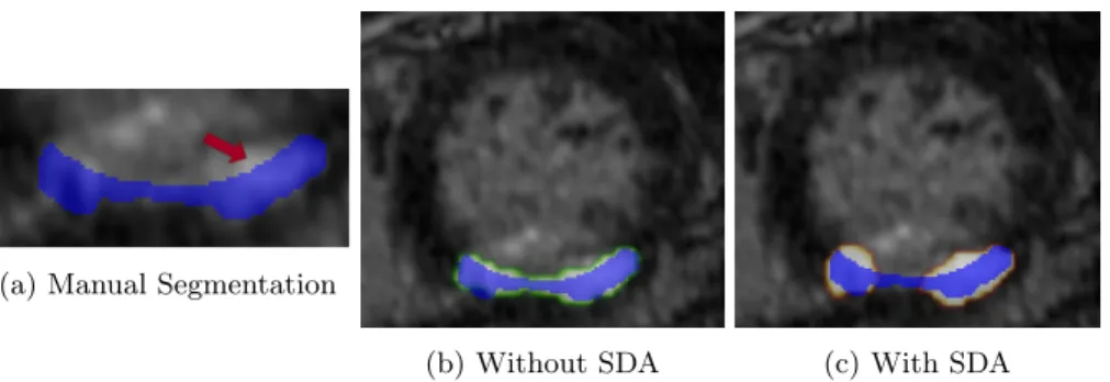Fig. 7: Training and Validation results of TCL-Net vs. Isensee’s (multi-modality dataset, first network with SDA).