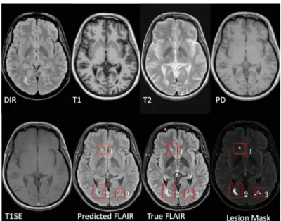 Fig. 1: FLAIR has better observer performance in the detection of multiple scle- scle-rosis (MS) lesions on magnetic resonance (MR) images of the brain