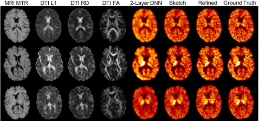 Fig. 3. Qualitative comparison of our method (“Refined”), a 2-layer DNN and the single cGAN (corresponding to the sketcher in our approach is denoted as “Sketch”) as well as the ground truth and the input MR images.