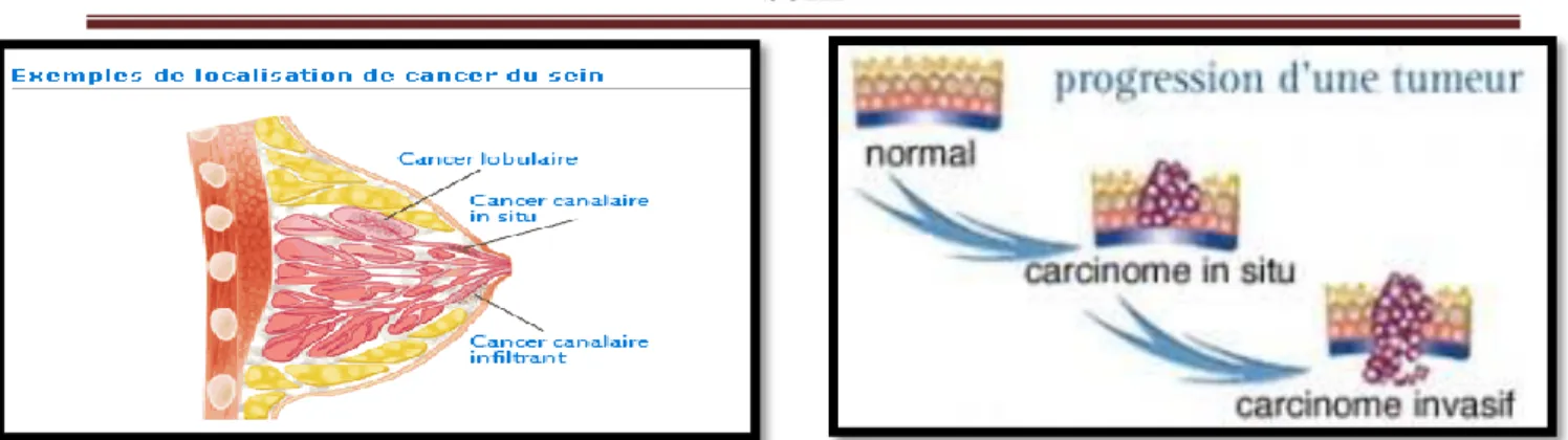 Figure  n°08 :  progression  d’une  tumeur  du  carcinome  in  situ vers un carcinome invasif 