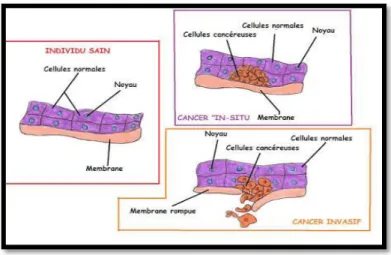 Figure n°10 : comparaison entre : tissu sein, cancer in situ et cancer invasif 38
