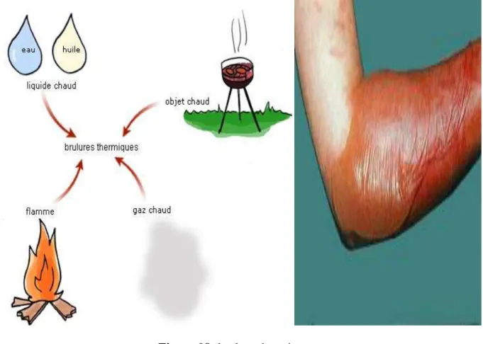Figure 08: brulure thermique 