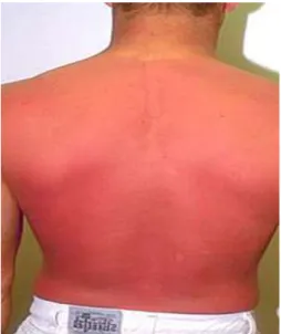 Figure 15 : brulure par frottement 