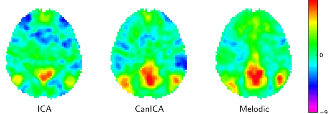 Figure 4: Default mode network extracted using different approaches: left: the simple Concat-ICA approach detailed in this article; middle: CanICA, as implemented in nilearn; right: Melodic’s concat-ICA