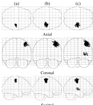 Fig. 3. Maximum Intensity Projection (MIP) of the RFX student-t maps for the Lc. – Rc