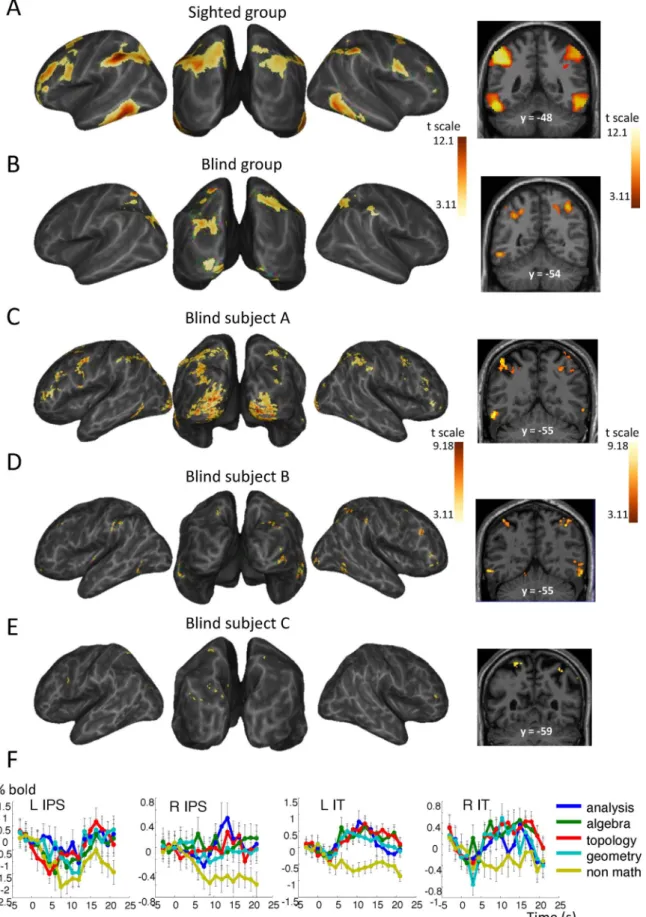 Fig. 2. Math-responsive network in blind and sighted mathematicians in experiment 1. Whole-brain inﬂated maps and coronal slice showing the contrast of meaningful math versus meaningful nonmath reﬂection in 15 sighted mathematicians (A), 3 blind mathematic